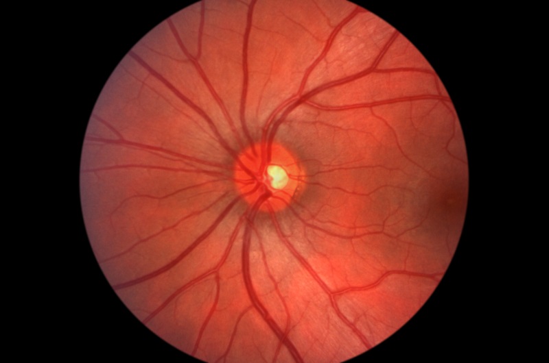 Glaucoma INSERT LOCATION